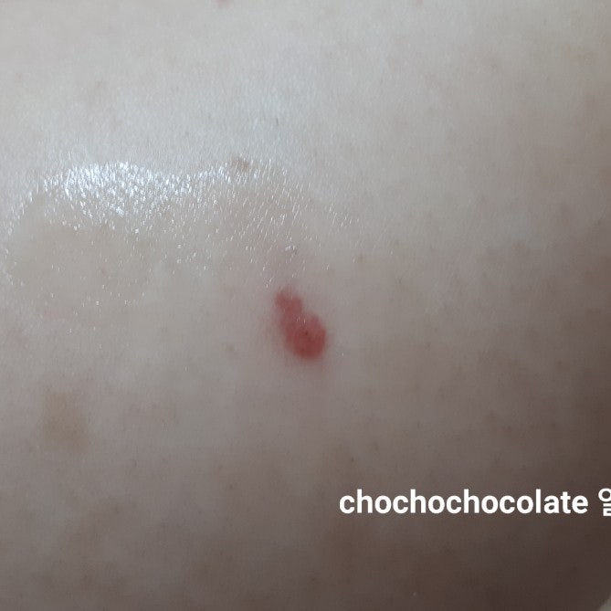 무는 파리, 샌드플라이 흡혈곤충 주의!벌레 물린 자국,대처법 : 네이버 블로그 무는 파리, 샌드플라이 흡혈곤충 주의!벌레 물린 자국,대처법 : 네이버 블로그