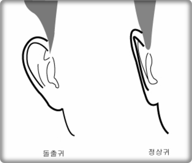  귀가 먹먹할때 멍멍할때 먹먹함 멍해요 막힌느낌 증상과 대처방법