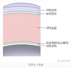  라섹은 무엇인가?