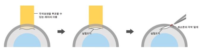  스마일 라식이 뭔가요??