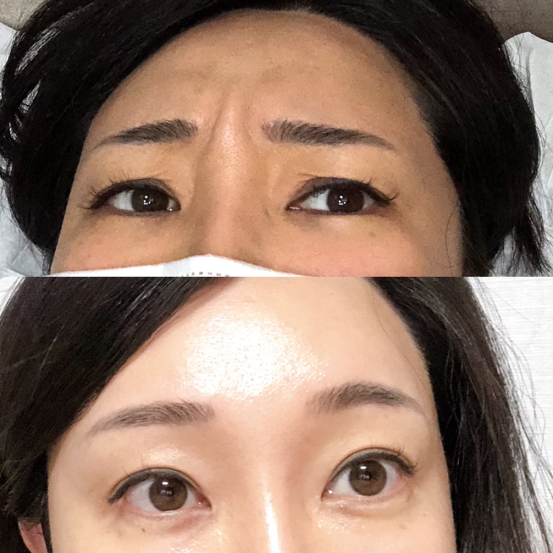 문정역피부과에서 스킨보톡스 11