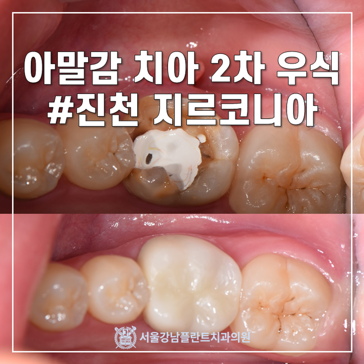 아말감 치료된 치아의 2차 우식, 잇몸까지 부어오른 심한 충치의 신경치료 (feat. 지르코니아 크라운)