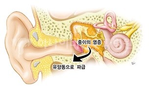귀에서 진물이 나요 - 성수이비인후과의 중이염치료 : 네이버 블로그