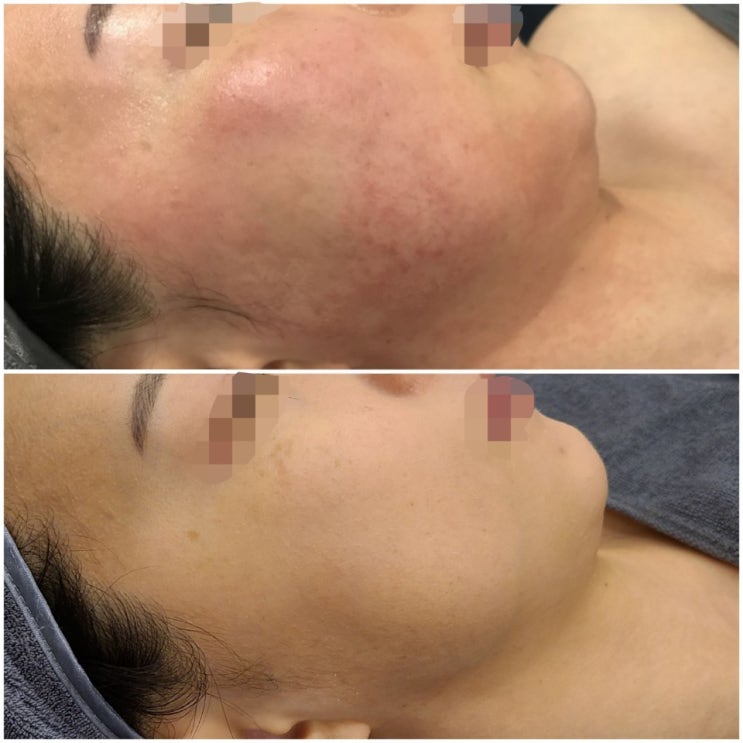  홍조피부 홍반피부 지루성피부염은 문제성피부전문 하이스킨