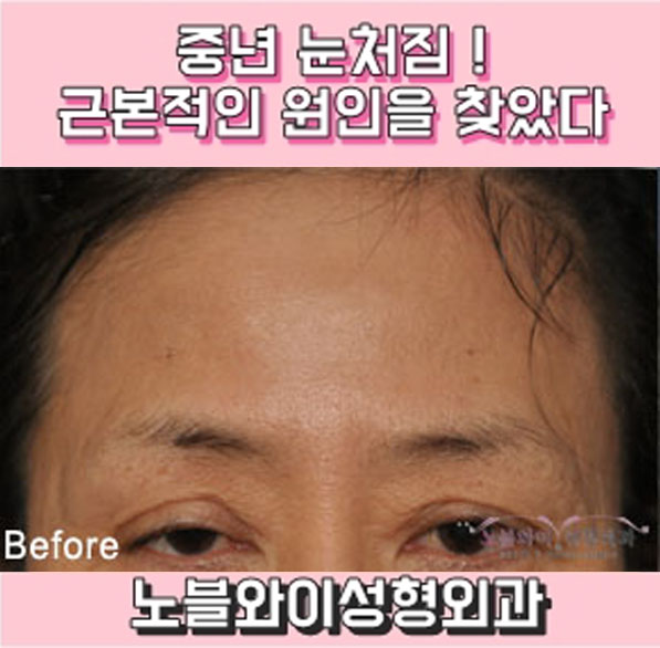  중년 눈처짐 오래 지속되네요 !