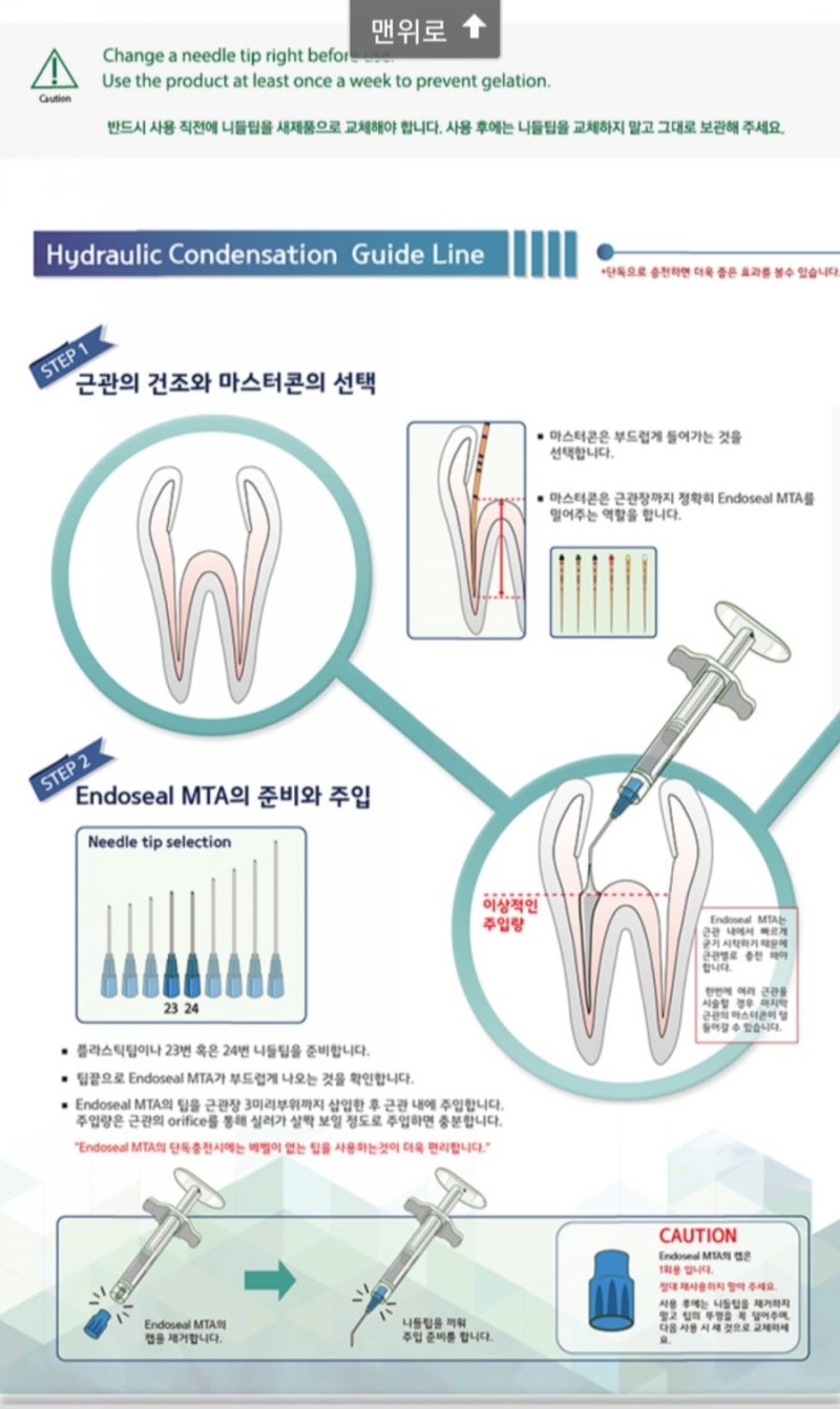 Endoseal MTA by Maruchi (엔도실) : 네이버 블로그