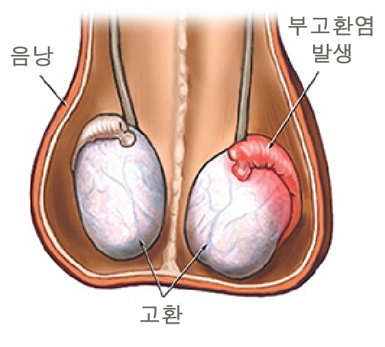  부고환염 치료 기간에 자위해도 될까