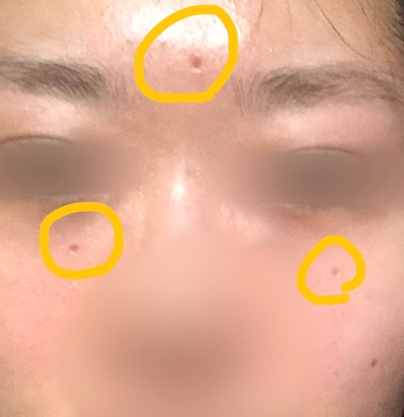 레이저 점빼기 시술 : 그 후 걱정과 고민거리 (점뺀후 파인 흉터, 재생주사) : 네이버 블로그 레이저 점빼기 시술 : 그 후 걱정과 고민거리 (점뺀후 파인 흉터, 재생주사) : 네이버 블로그