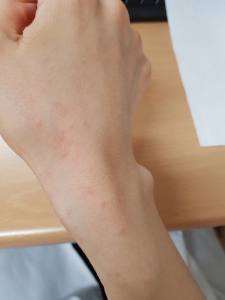  접촉성 피부염 일지 첫날(풀독)