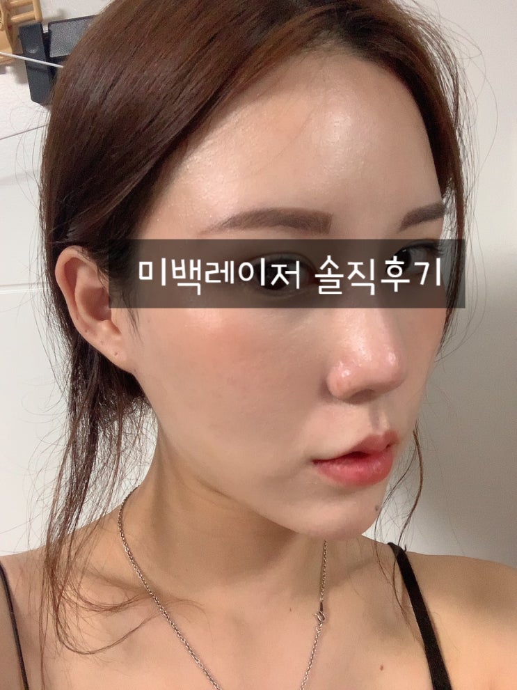  미백레이저 [CO2 + IPL + 크라이오셀] , 잡티제거 어뉴클리닉 내돈후기