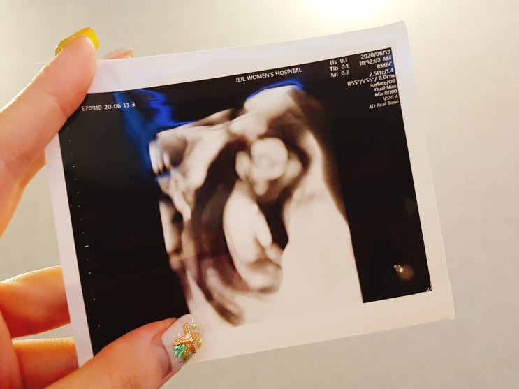  임신일기⑥ [12주차 증상] 1차 기형아검사,입체초음파 실패^^;; +태아보험가입