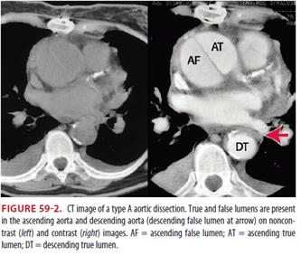  응급의학 - Ch.59 Aortic Dissection and Related Aortic Syndromes