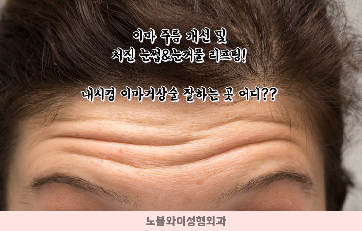  내시경 이마거상술 잘하는곳 눈썹까지 리프팅?!