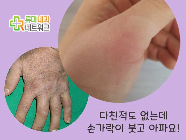 걱정 없는 손목통 수술