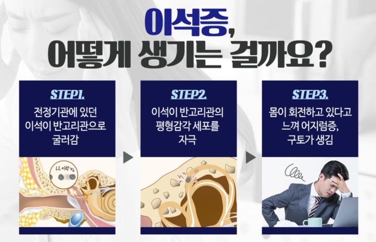  이석증 30대40대발생증가,이석증원인과 자가치료방법