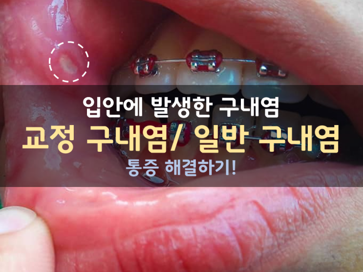 교정으로 발생한 구내염 원인과 해결 방법! / 일반구내염, 교정구내염, 교정 통증 해결하기! / 미사교정치과