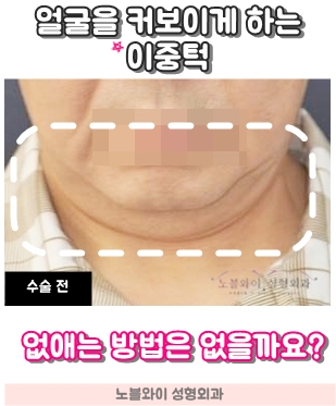  이중턱 실리프팅 효과 있나요??