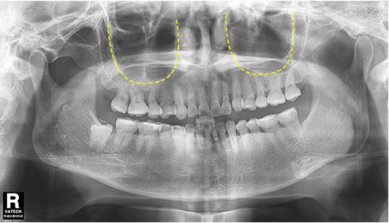 Multi-Sinus Dental 상악동 리프팅 치과를 선택하는 것이 왜 중요한가요? 10