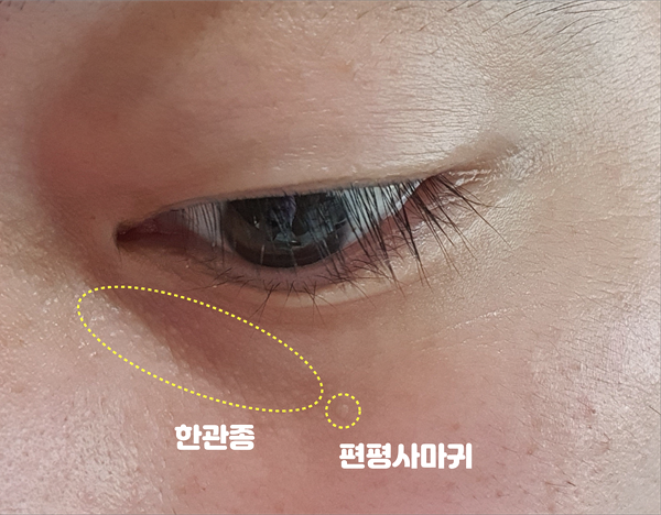  눈밑에 볼록볼록한 이것, 한관종인가요? 비립종인가요?