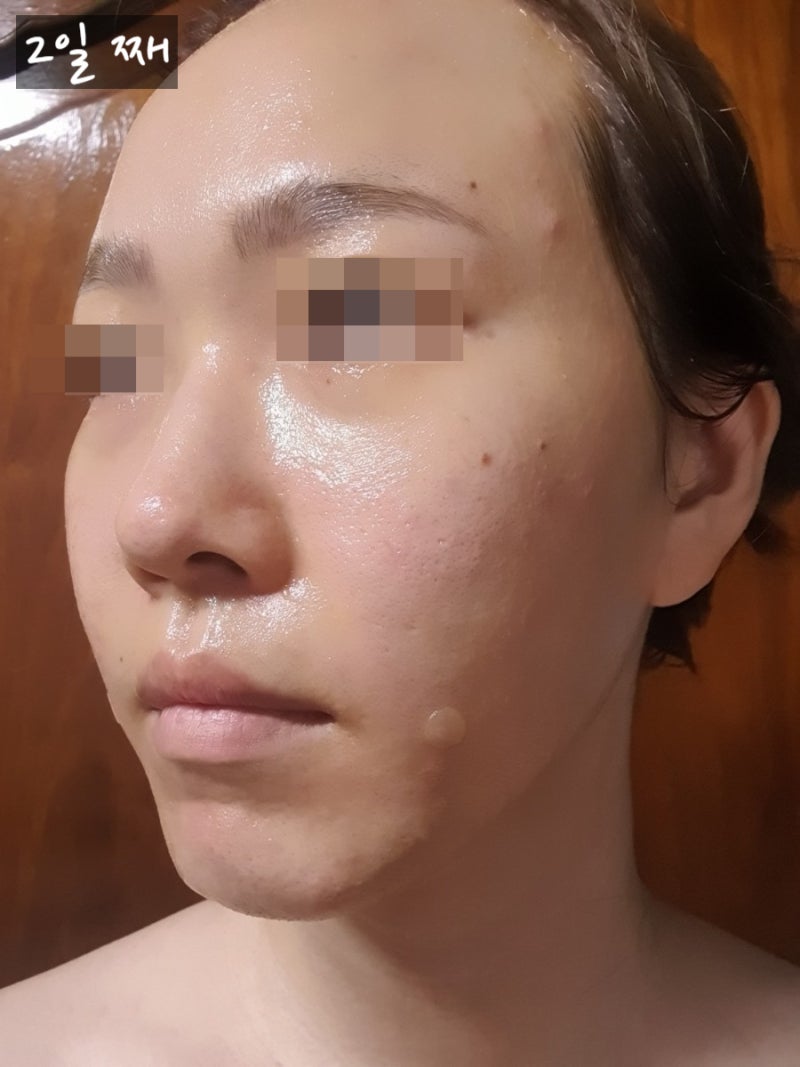 [팔자주름 스컬트라 후기] 튠컬트라 5