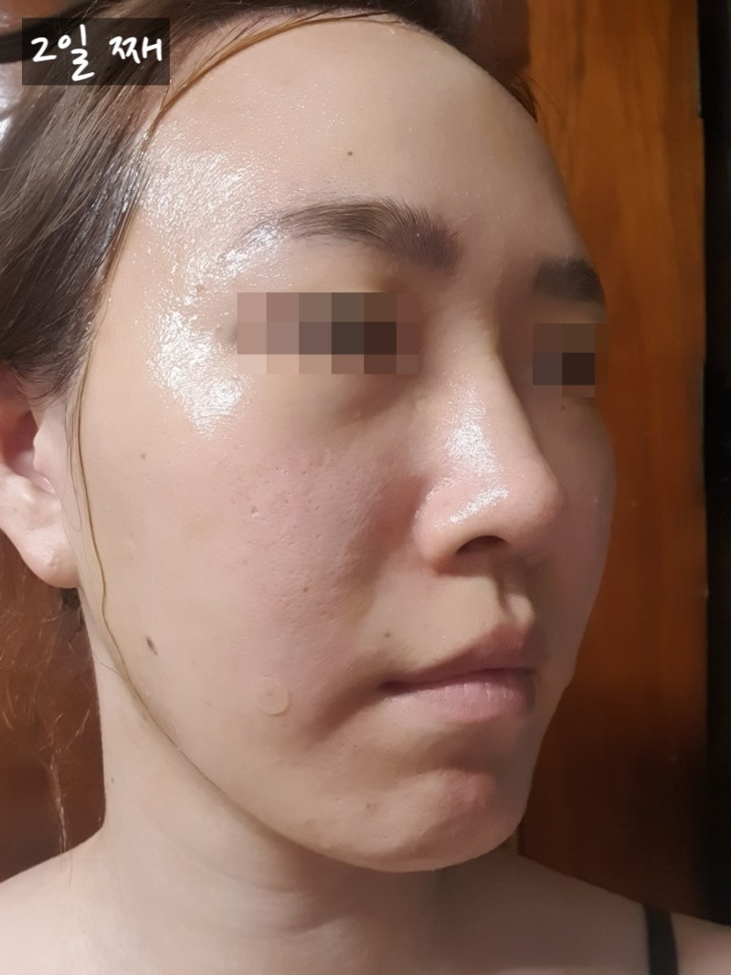 [팔자주름 스컬트라 후기] 튠컬트라 11