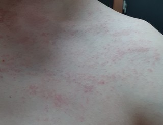  [버섯알레르기] 손톱할퀸 것처럼 빨간 피부발진, <버섯 알레르기>라는 진단