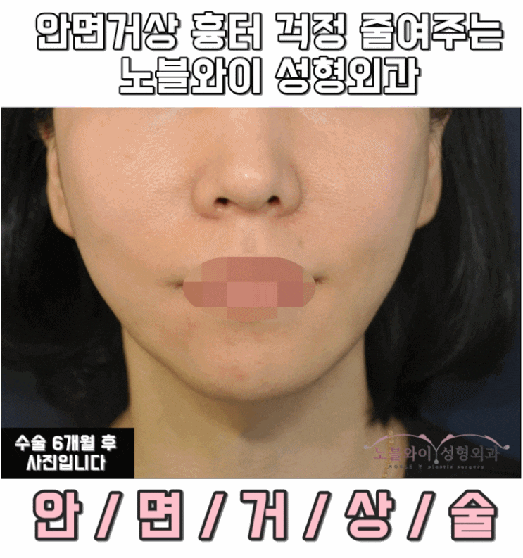  안면거상술 흉터 어떻게 하면 안생겨요??