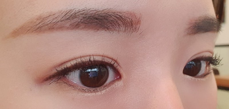 자연유착 쌍꺼풀재수술 세달차 후기