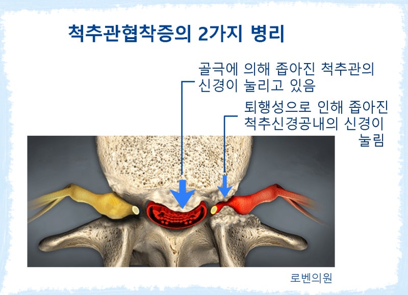 허리협착척추관협착증 비수술신속치료병원