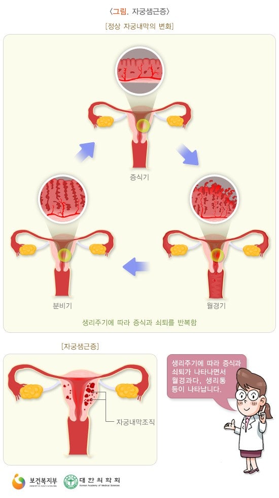 자궁선근증 밀레날루프 시술치료 5개월 경과, 통증 부작용 후기 자궁선근증 밀레날루프 시술치료 5개월 경과, 통증 부작용 후기