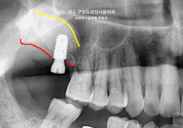  상악동 뼈이식 간단하게 진행하기, 원주 무실동 삼성서울치과, 원주 임플란트 잘하는 곳