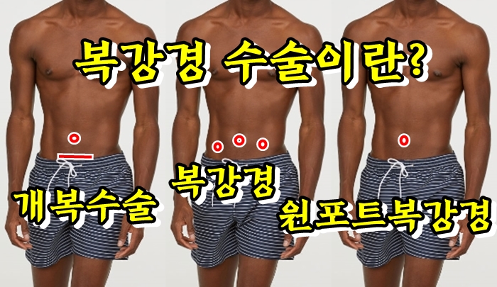  위궤양, 충수염 복강경 수술