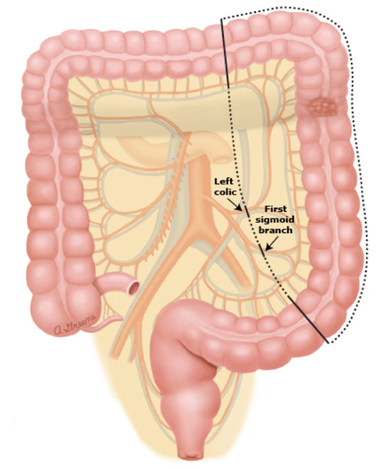 대장절제술(colectomy) : 대장암(colon cancer), 대장염(colitis) 등 대장질환의 위치에 따라 절제 ...