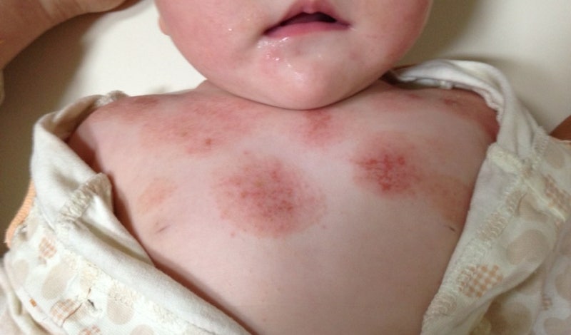 물 알레르기의 초기 증상 4