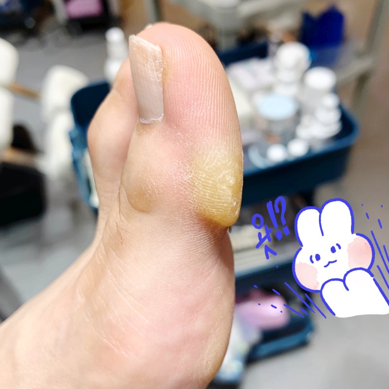 엄지발가락 굳은살 제거 노란굳은살 갈아서 제거하기 : 네이버 블로그 엄지발가락 굳은살 제거 노란굳은살 갈아서 제거하기 : 네이버 블로그