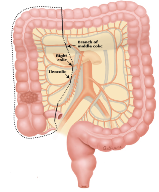 대장절제술(colectomy) : 대장암(colon cancer), 대장염(colitis) 등 대장질환의 위치에 따라 절제 ...