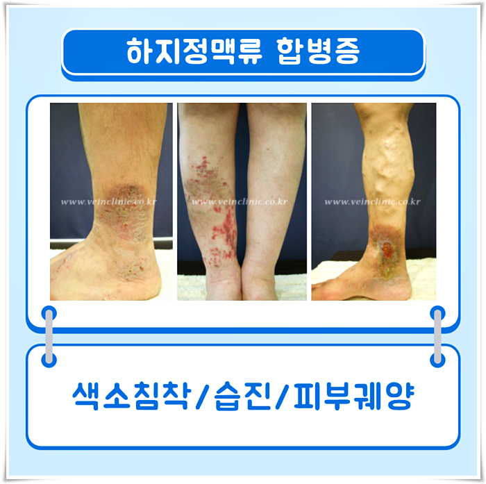 간단한 스트레칭으로 하지정맥류의 초기 증상을 관리하여 예방합니다. 2