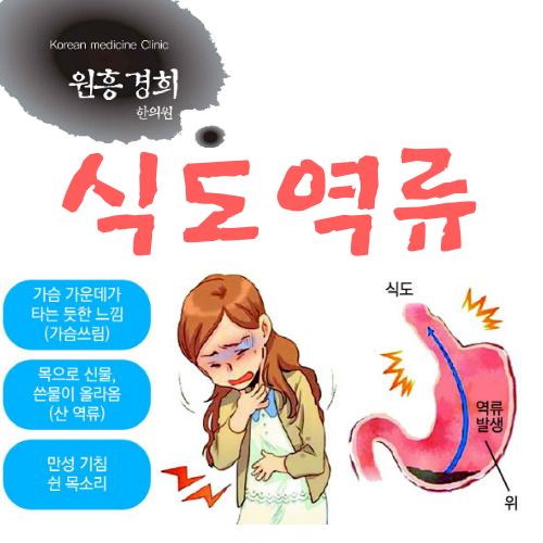  식도역류