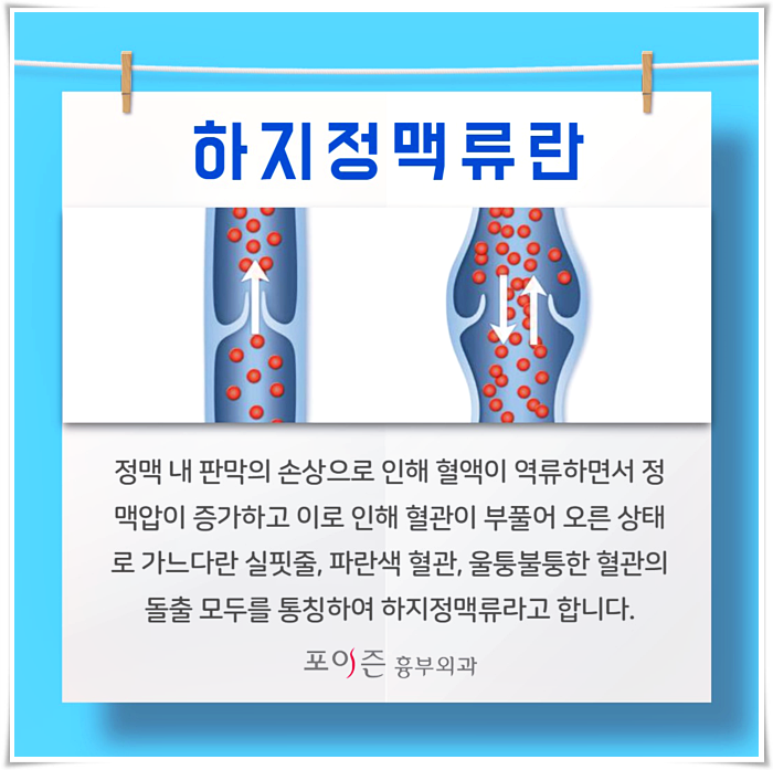 간단한 스트레칭으로 하지정맥류의 초기 증상을 관리하여 예방합니다. 4