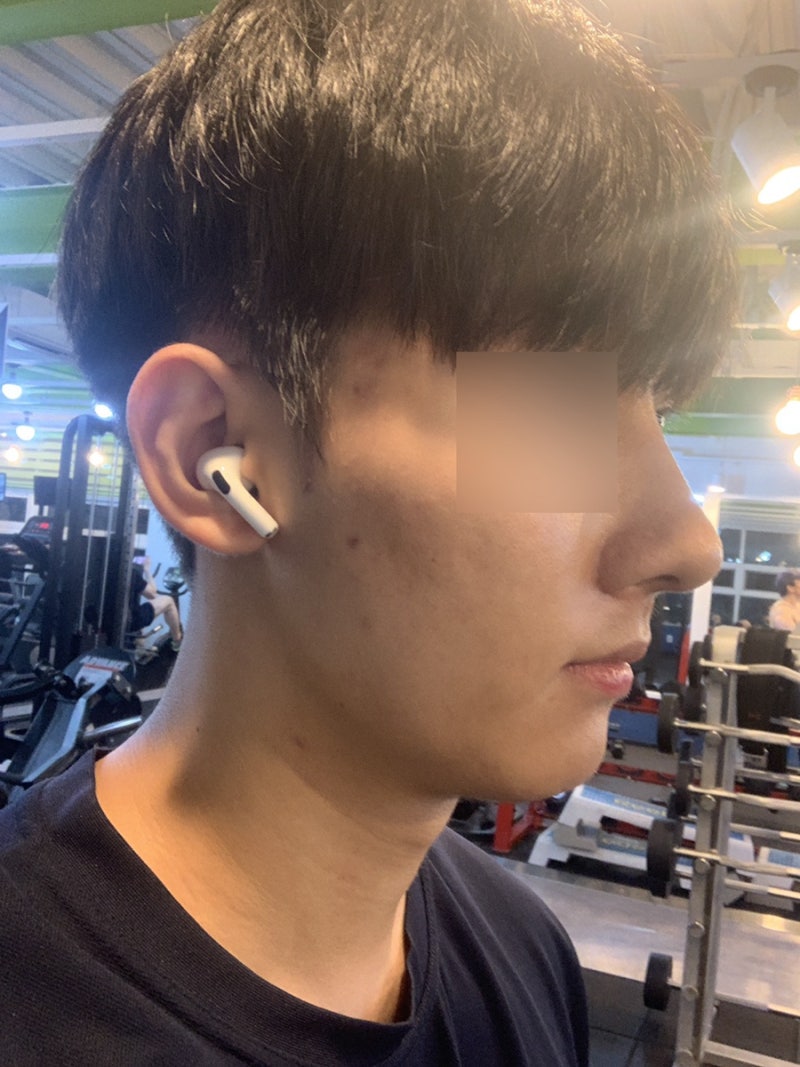 남자 코성형 하고온 친구 솔직 후기 한달차, 절개흉 등 전후 사진 : 네이버 블로그 남자 코성형 하고온 친구 솔직 후기 한달차, 절개흉 등 전후 사진 : 네이버 블로그