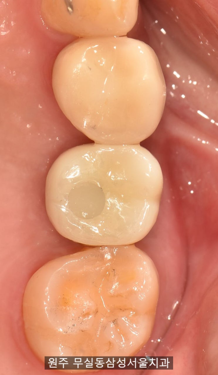  어금니 임플란트 치료, 원주 임플란트 잘하는 곳, 원주 무실동 삼성서울치과
