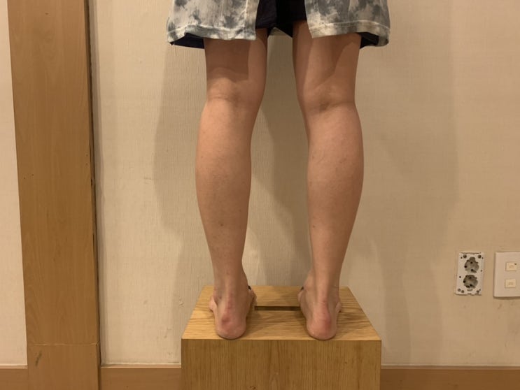  종아리 알빼기 :: 청담피부과 종아리 보톡스 후기 , 유스키니 종아리시술 3주차 후기