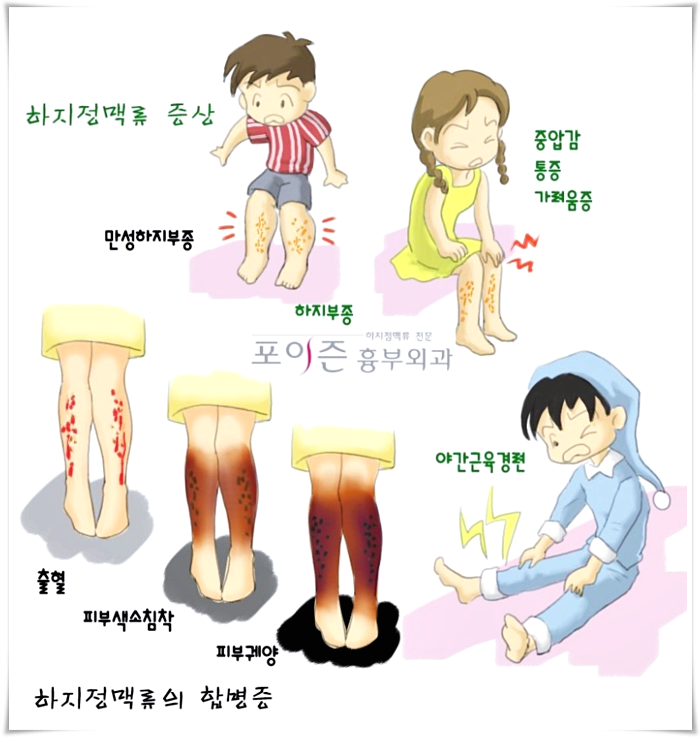 간단한 스트레칭으로 하지정맥류의 초기 증상을 관리하여 예방합니다. 간단한 스트레칭으로 하지정맥류의 초기 증상을 관리하여 예방합니다.