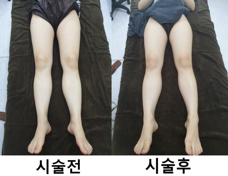  [일산척추교정][일산체형교정][파주척추교정][파주체형교정] 다이어트슬리밍라인마사지