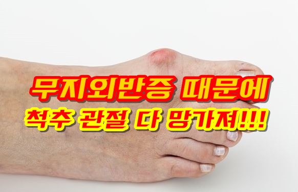  무지외반증 기능성신발로 교정된다