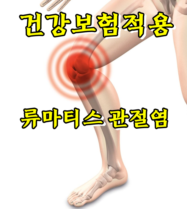  녹(백)내장 초음파, 류마티스 관절염도 건강보험 적용된다고 하네요.
