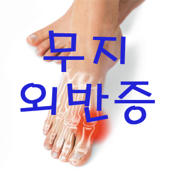  엄지발가락 통증, 무지외반증이란?