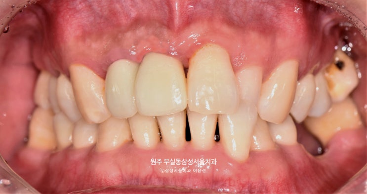  앞니(전치부) 임플란트 치료 증례, 원주 무실동 삼성서울치과, 원주 임플란트 잘하는 곳