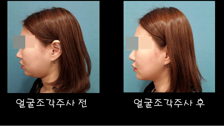 날씬한 얼굴을 위한 강남얼굴윤곽주사 리뷰/합리적인 얼굴지방분해 주사비용!! <갤럼 주사 1회차> 7