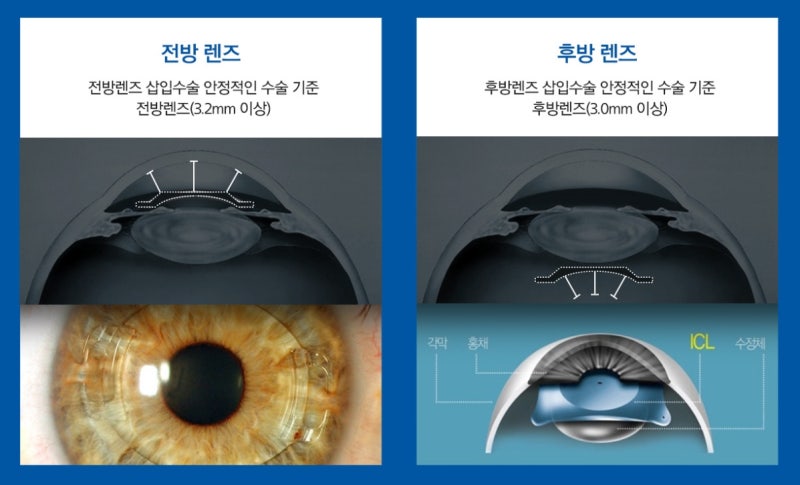 Goyang Shinsegae Ophthalmic Cataract Lens Insertion EIHANS 100,000 cases achieved and received a plaque of achievement
